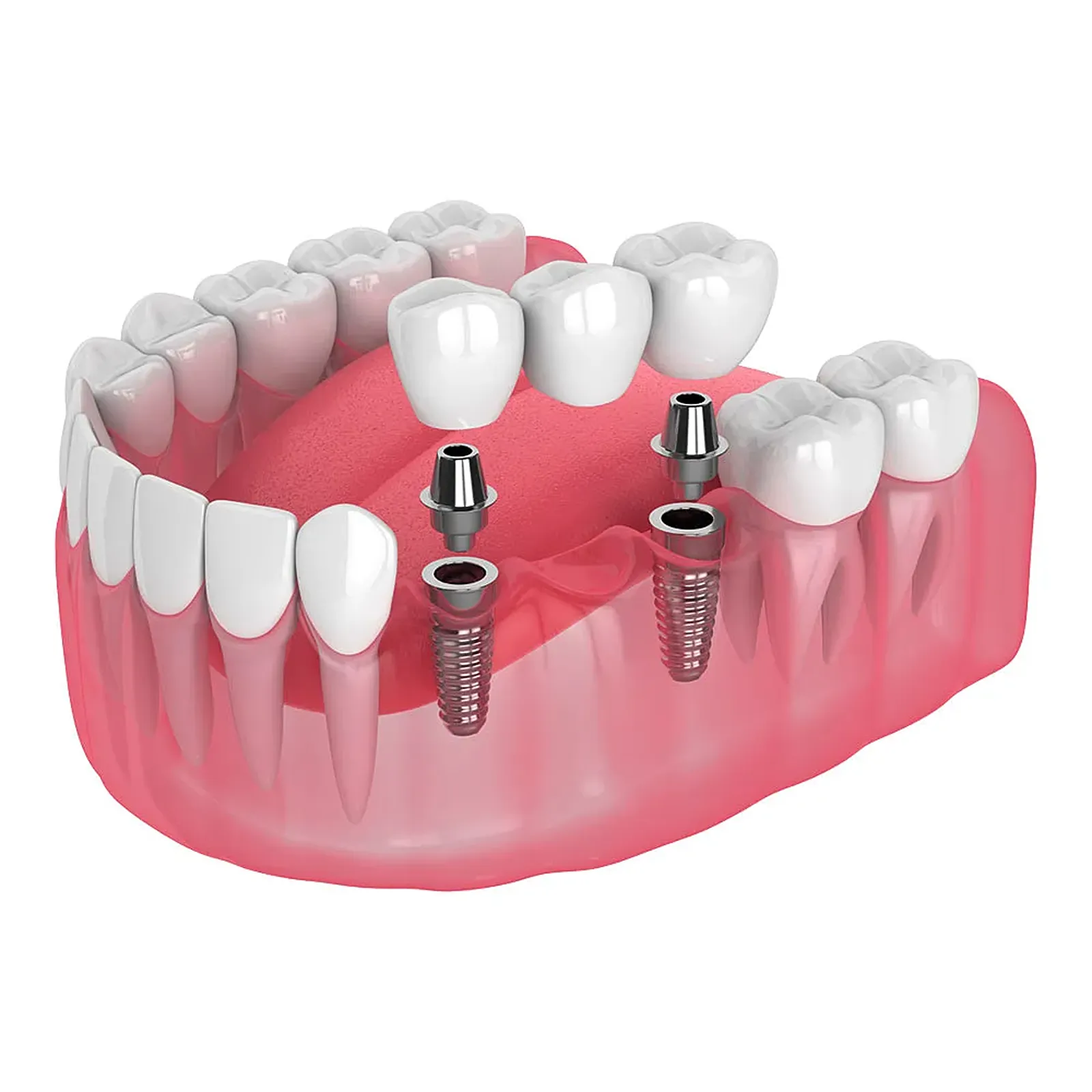 Implant Supported Bridge