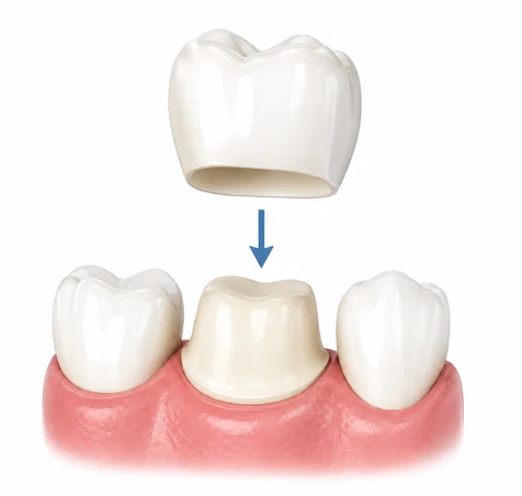 All Ceramic Crowns