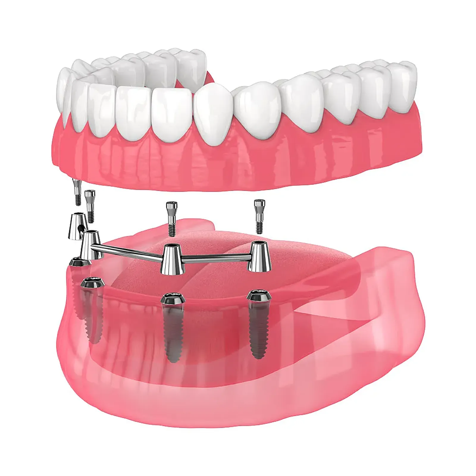 Implant Supported Dentures