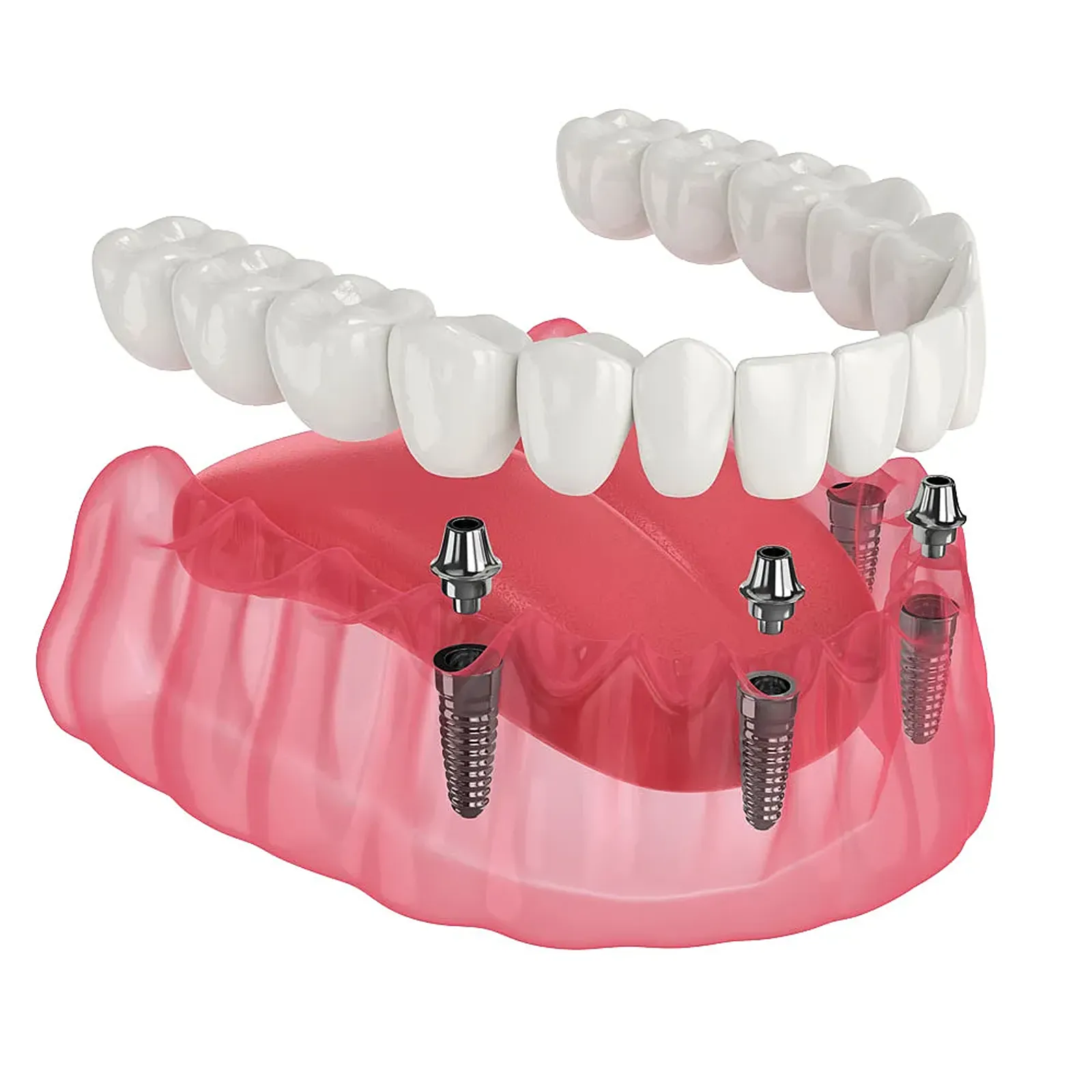 All-on-4 Implants