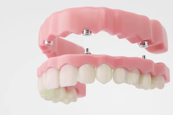 Full dentures in Sycamore IL