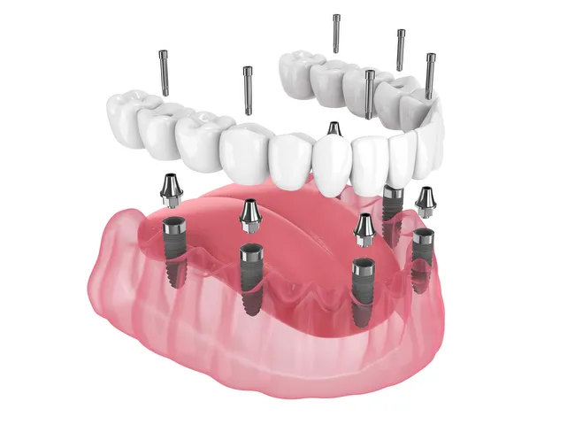 Implant-supported dentures in Sycamore IL