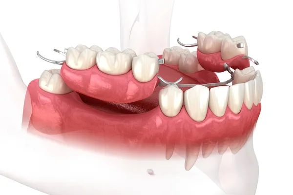 Partial dentures in Sycamore IL