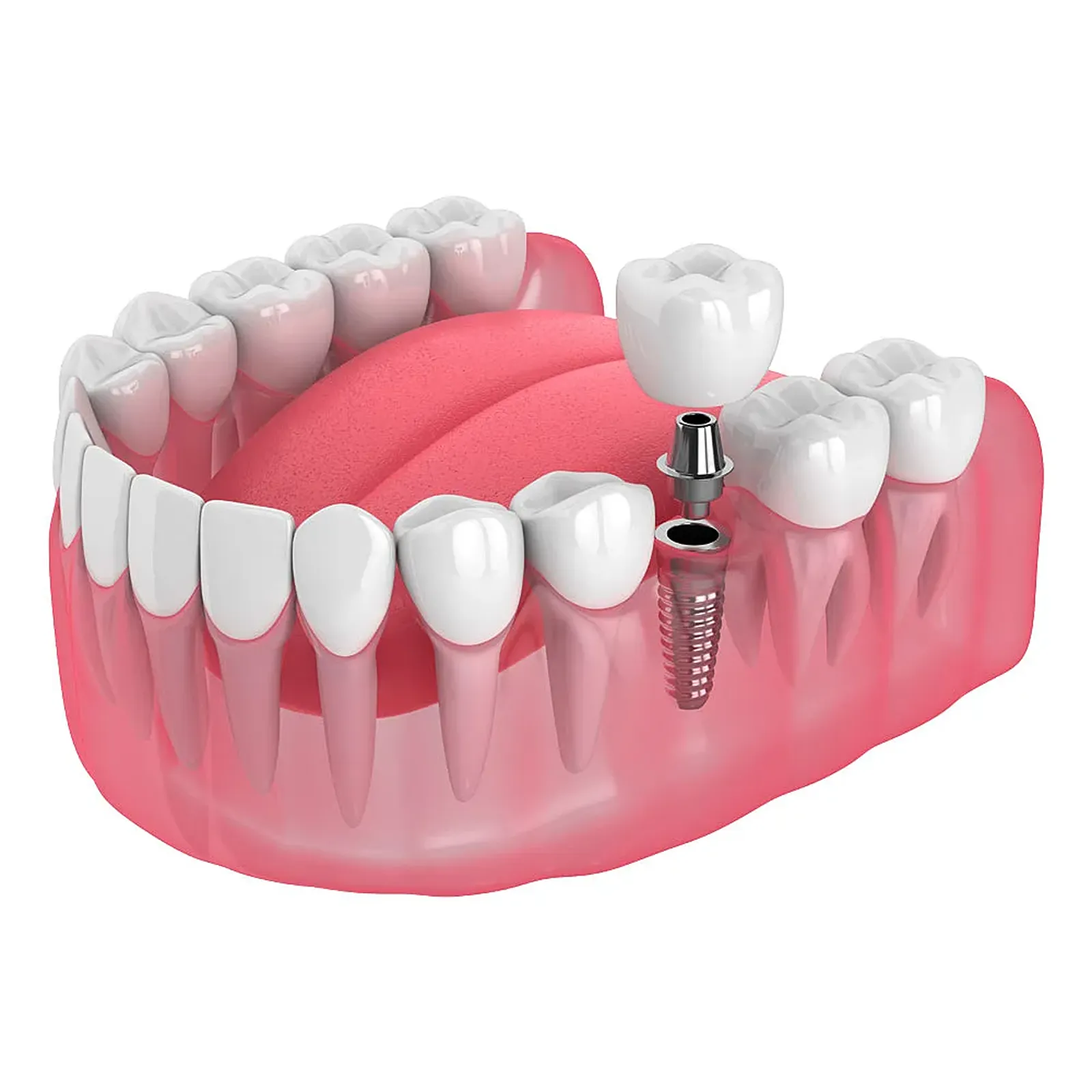 Implant Retained Crowns